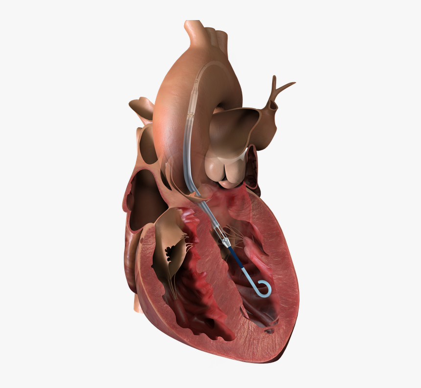 The Impella Left Ventricular Assist Device - Impella 5.5, HD Png Download, Free Download