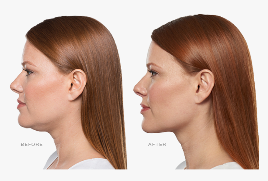 Kybella Double Chin Before And After, HD Png Download, Free Download