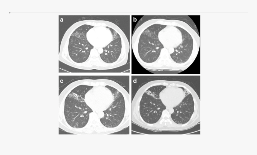 Mycobacterium On Ct Scan, HD Png Download, Free Download