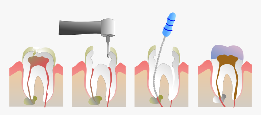 Root Canal Treatment, HD Png Download, Free Download