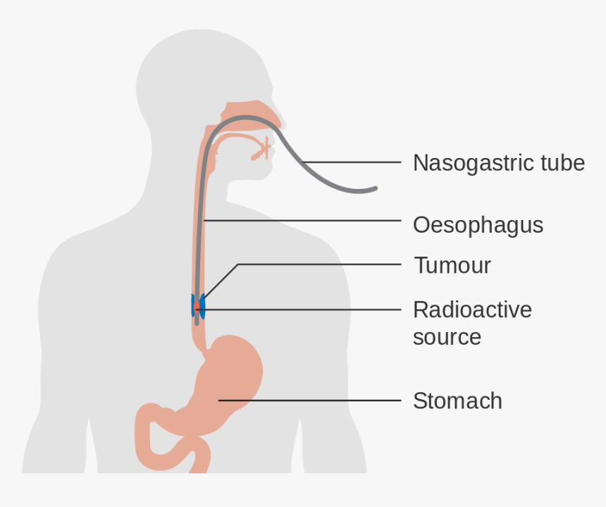 Esophageal Cancer Causes - Illustration, HD Png Download, Free Download