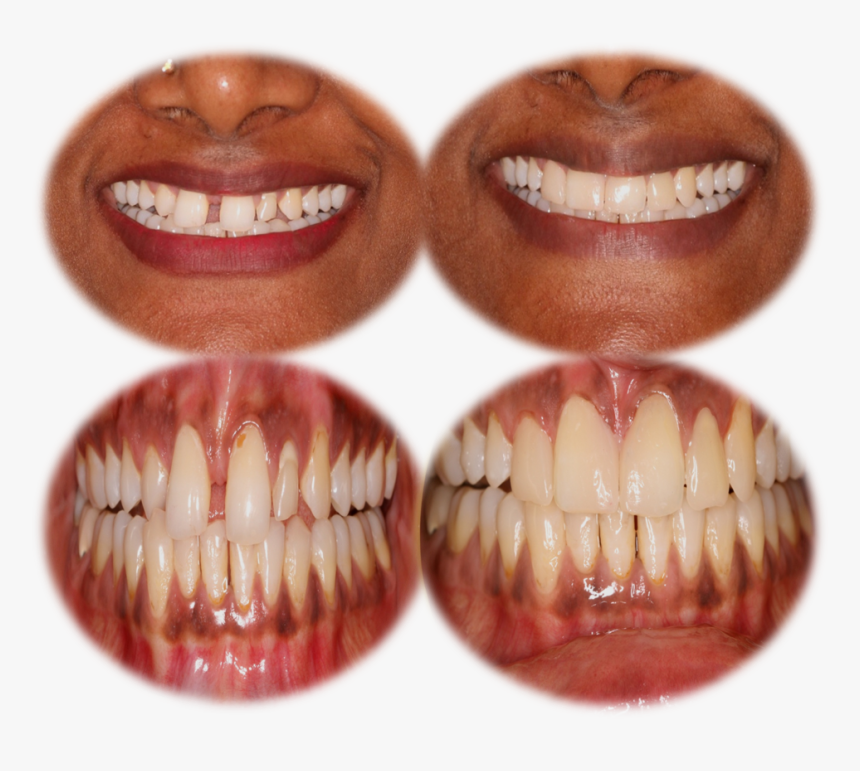 Teeth Gap Filling Cost In India,chennai - Tooth Bleaching, HD Png Download, Free Download