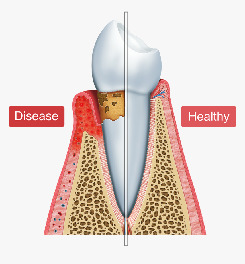 Digital Illustration Showing Healthy Gums Vs - Periodontal Pocket Png, Transparent Png, Free Download