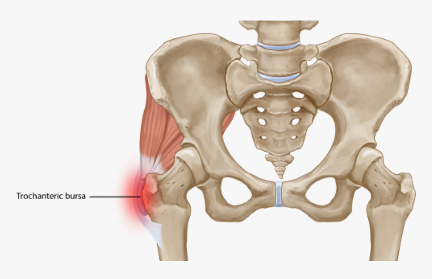 Trochanteric Bursitis, HD Png Download, Free Download