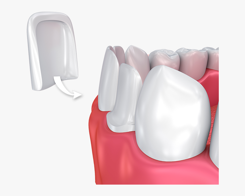 Porcelain Veneers - Dental Veneers Png, Transparent Png, Free Download