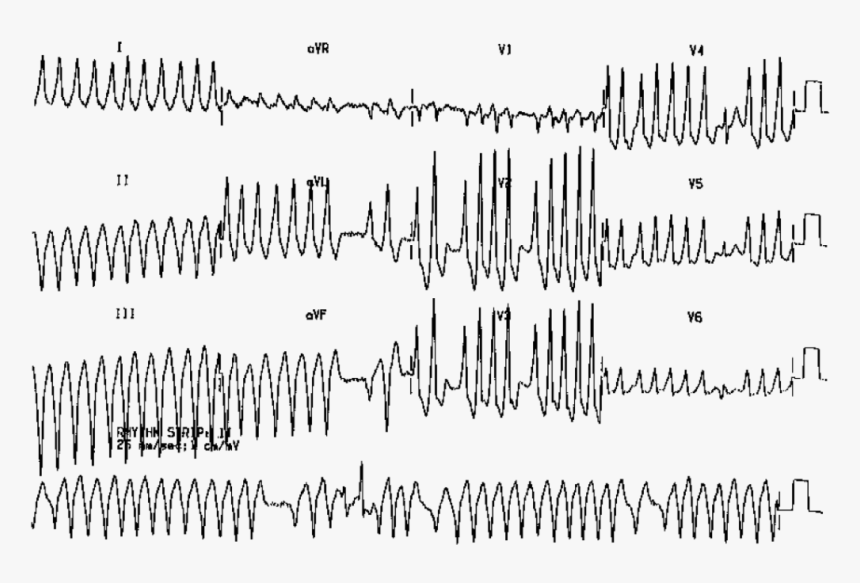 Wpw Syndrome With Atrial Fibrillation, HD Png Download, Free Download