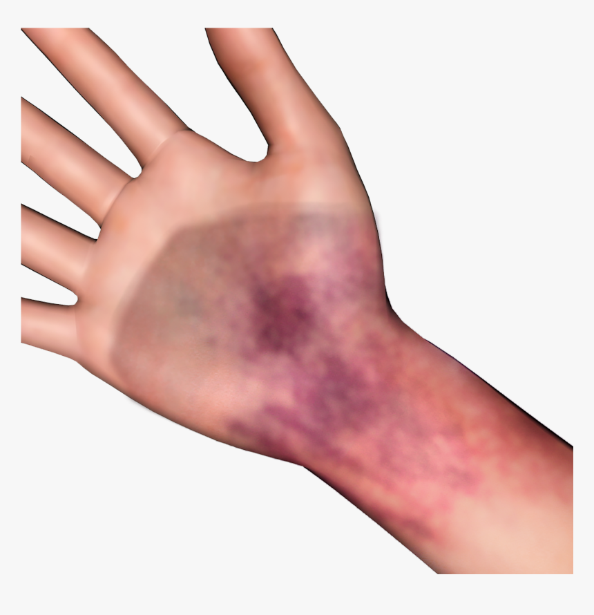 Bruise Png, Transparent Png, Free Download