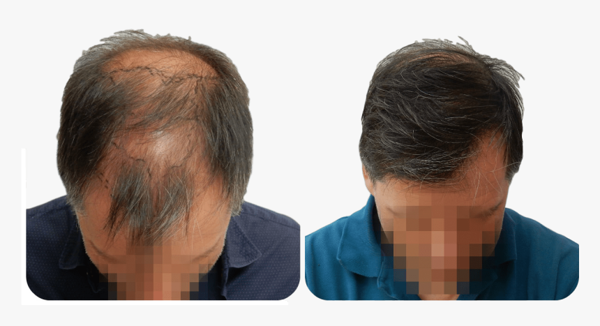 Fue Hair Transplant Result, HD Png Download, Free Download