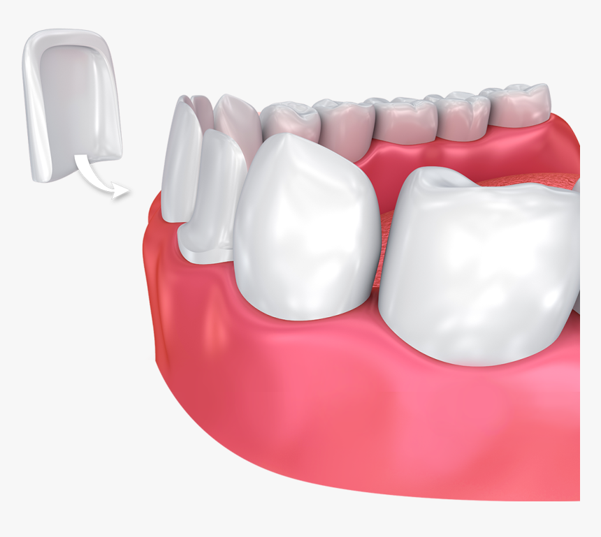 Veneers Teeth, HD Png Download, Free Download