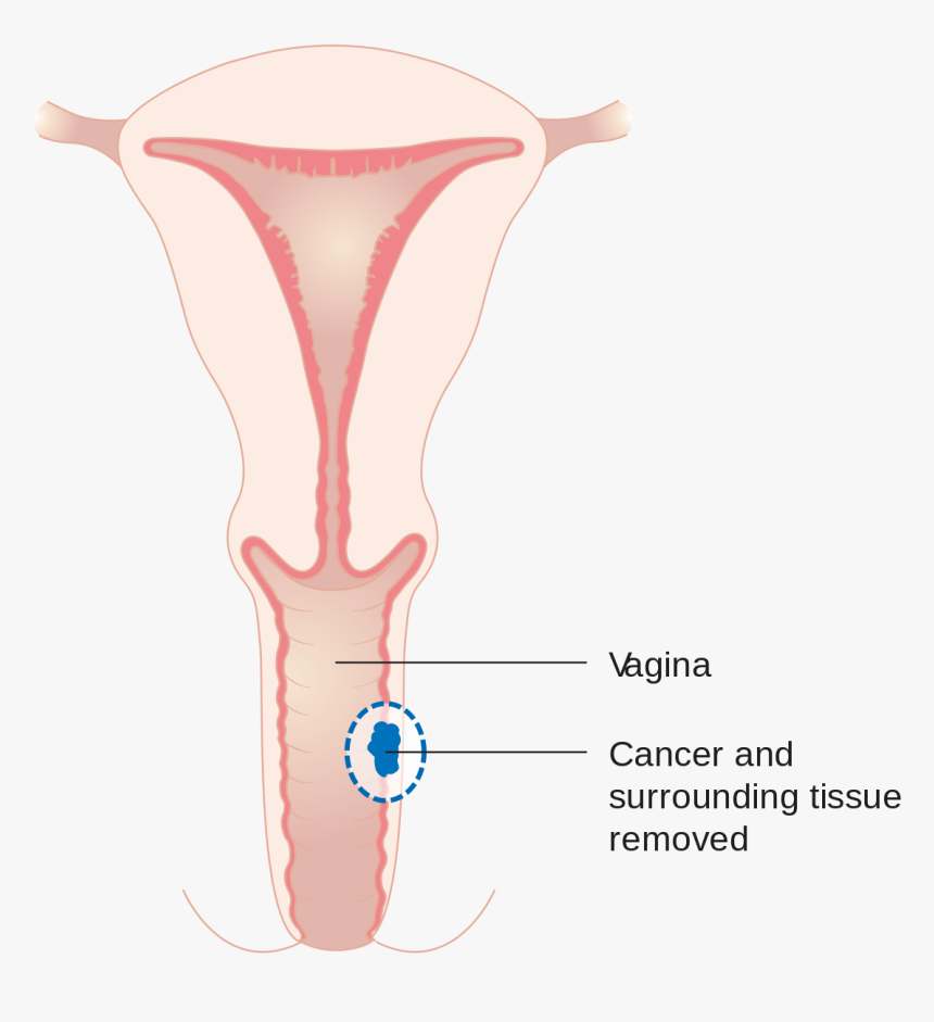 Vajina Cancer, HD Png Download, Free Download