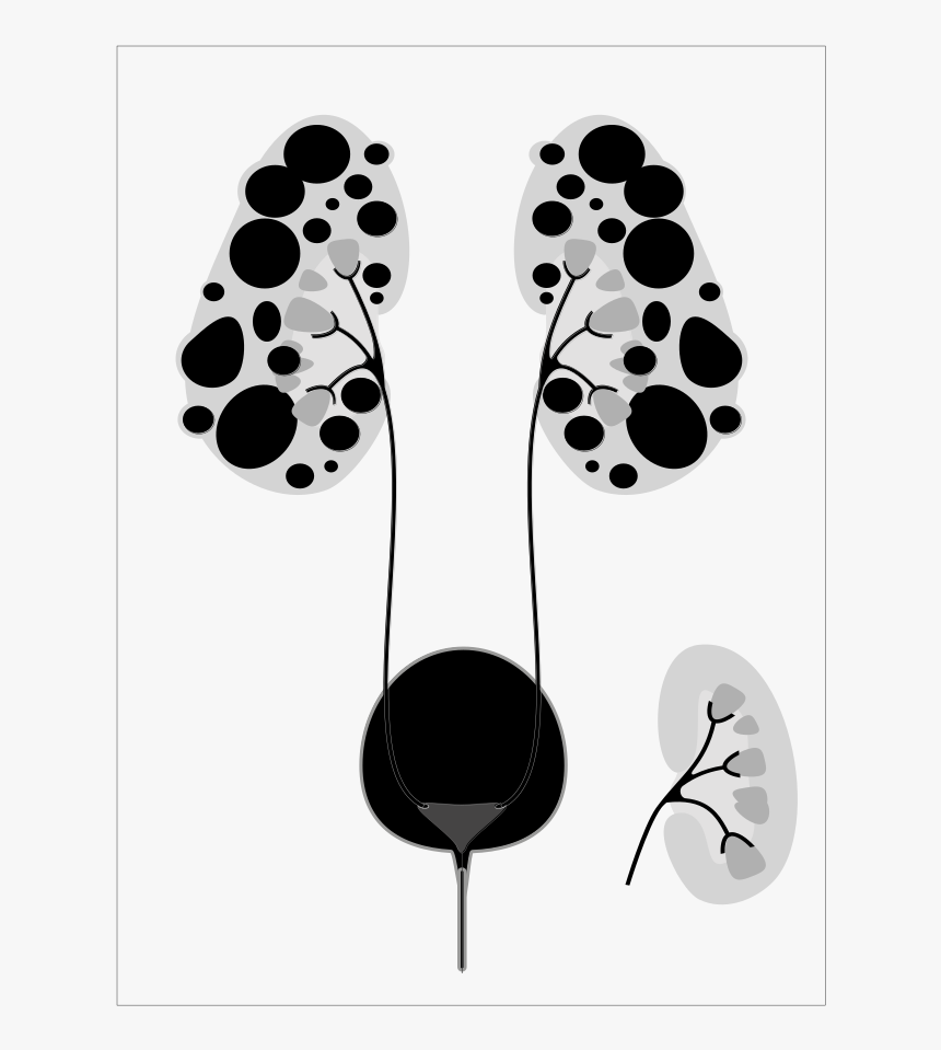 Polycystic Kidney Cartoon, HD Png Download, Free Download