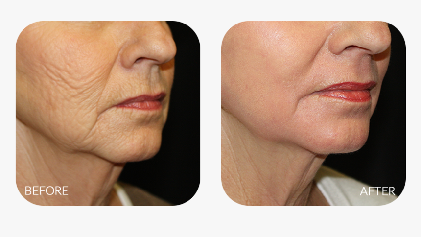 Chemical Peel Neck Before And After, HD Png Download, Free Download