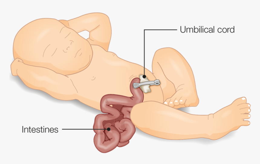 Illustration Of A Baby With Gastroschisis Showing Intestine - Cartoon, HD Png Download, Free Download