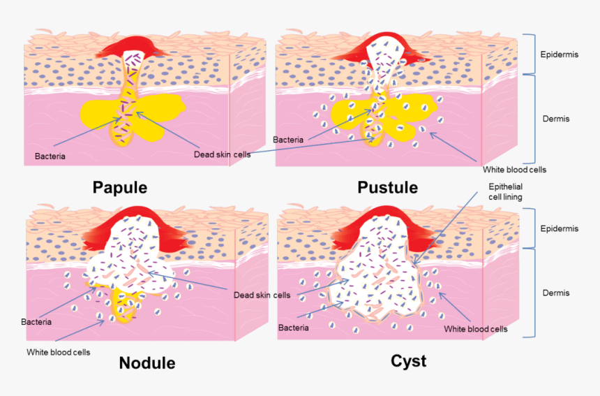 Cystic Acne Shiro Aesthetic Clinic Singapore - Acne Treatment For T Zone, HD Png Download, Free Download