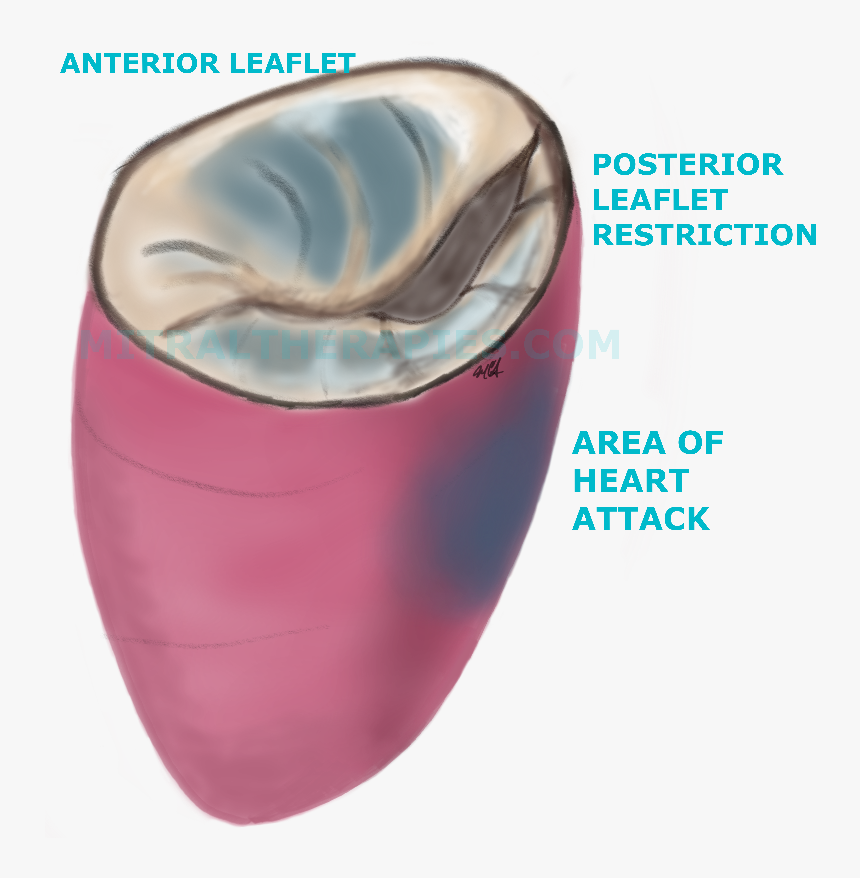 In Ischemic Mitral Regurgitation Or Leakage From Damage - Mouth, HD Png Download, Free Download