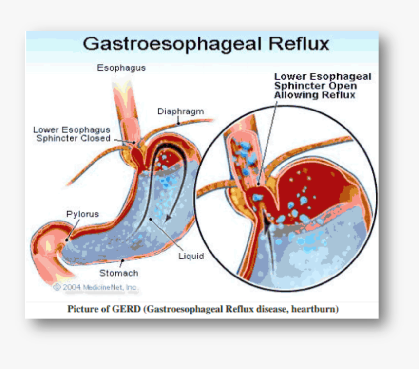 Reflux Oesophagitis Grade 2, HD Png Download, Free Download